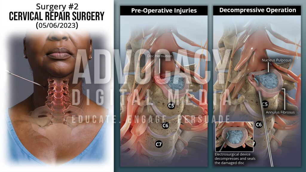 Cervical Repair Surgery Trial Illustration