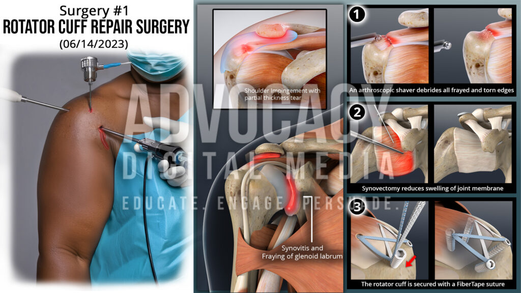 Rotator Cuff Trial Illustration